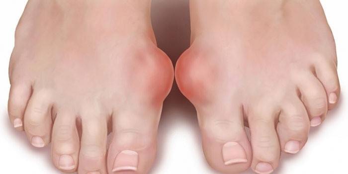 Такі процедури для лікування подагри сприяють поліпшенню функції хворих суглобів, видалення з них надлишкової кількості уратів