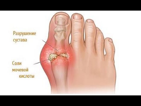 Лікування подагри в домашніх умовах
