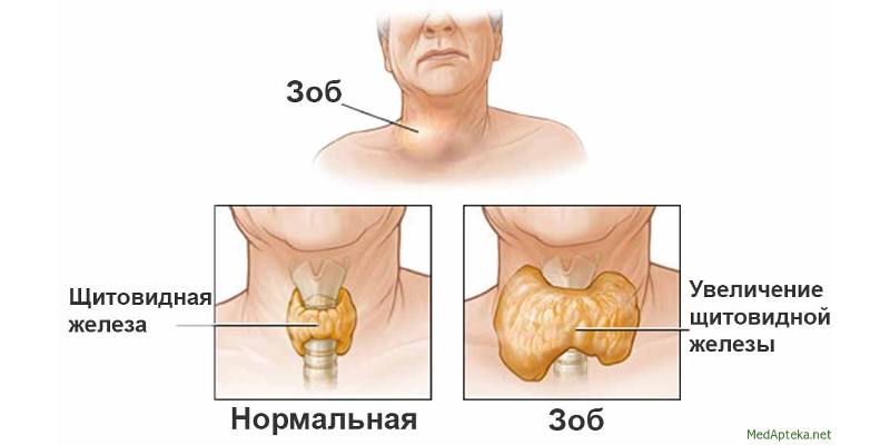симптоми зоба