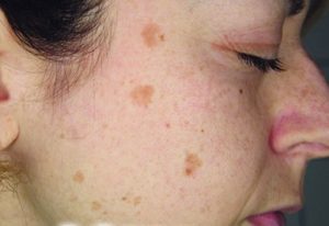 Зміст статті   Бешиха - інфекційне захворювання, що вражає шкірні покриви