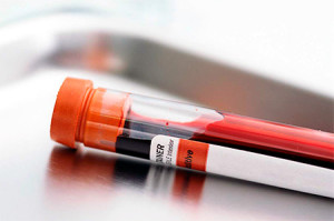 Зміст статті За статистикою майже кожна людина в світі інфікований Herpes Simplexvirus, ДНК-містять видів, сімейства Herpeveridae, в складі якого губної, генітальний, цитомегаловірус, Varicella-zoster, Епштейна-Барр і віруси 6, 7, 8 типу