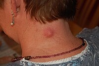 У рідкісних випадках атерома може трансформуватися в злоякісне новоутворення