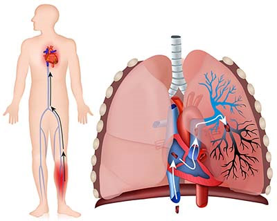 різноманітність іррідаціі болів при інфаркті міокарда