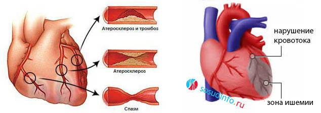 Якщо не звертати увагу на напади давили або пекучих болей за грудиною, можна отримати небезпечне ускладнення стенокардії у вигляді обширного інфаркту міокарда, який не тільки згодом призведе до хронічної серцевої недостатності, а й може закінчитися летальним результатом