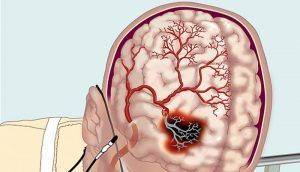 Про те, що таке   церебральний атеросклероз   , Іменований «старечим склерозом», знають навіть люди, далекі від медицини