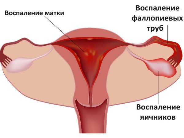Лікується захворювання переважно комплексно, із застосуванням антибактеріальних препаратів