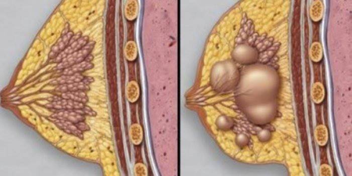 дифузна ФКМ