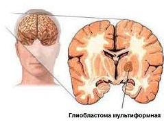 Виділяють 4 основні форми астроцитоми, вони ж відображають і стадії розвитку пухлини, ступеня її злоякісності: