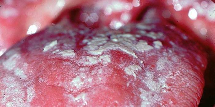 кандидозний