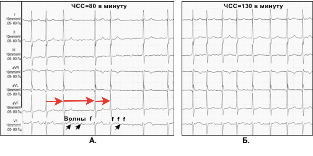 При тривало існуючій миготливої аритмії або зверненні в момент нападу - досить зареєструвати ЕКГ і підтвердити наявність даного виду аритмії