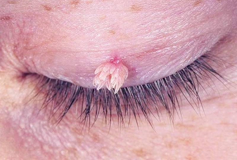 ВПЛ присутній у 70% дорослого населення, але при відсутності сприятливих факторів вірус знаходиться в сплячому стані