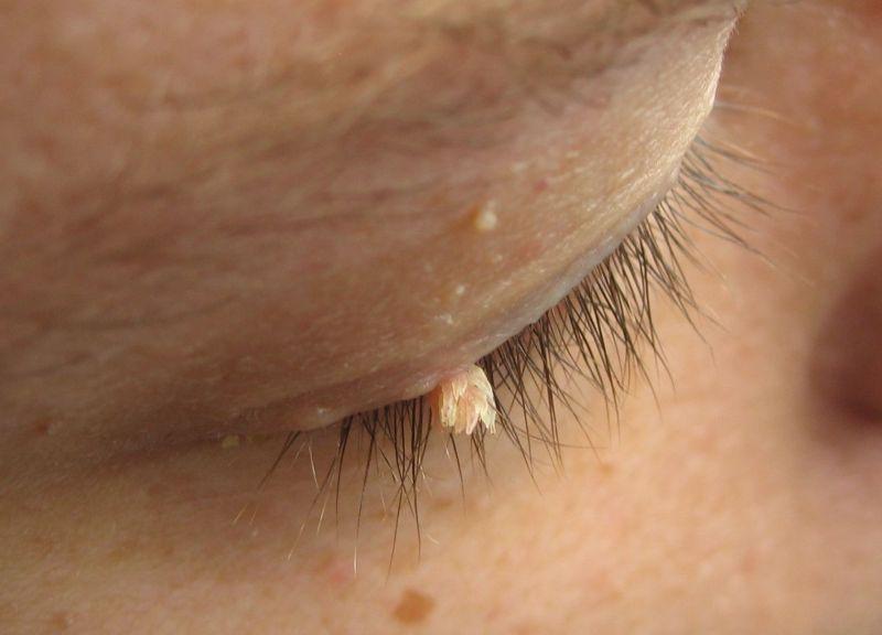 Як виглядають папіломи можна розглянути на фото