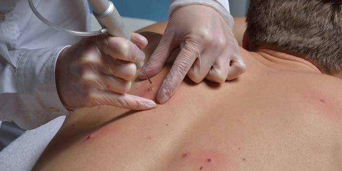 Головний мінус процедури - можливо після неї залишиться невеликий шрам