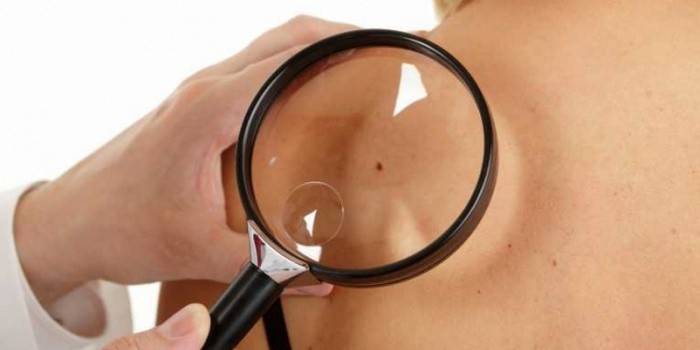 Додатково можуть бути призначені Диазолин, Супрастин, Біфідумбактерин або Лінекс