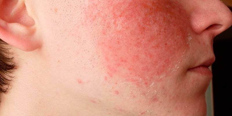 Червоні плями на обличчі виникають не просто так, особливо якщо носять минаючий характер