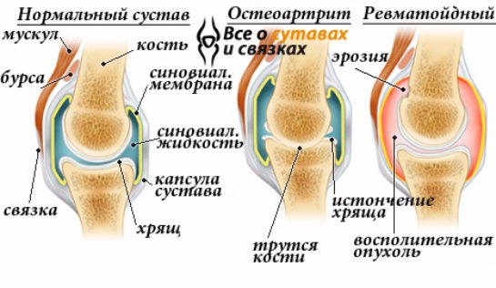 Втім, лікування артриту суглобів сьогодні проходить досить успішно