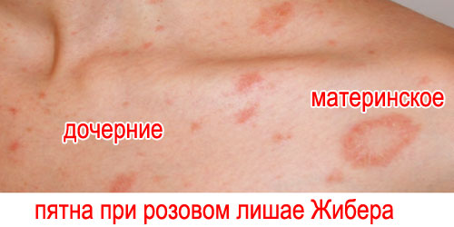 На фото: дочірні плями