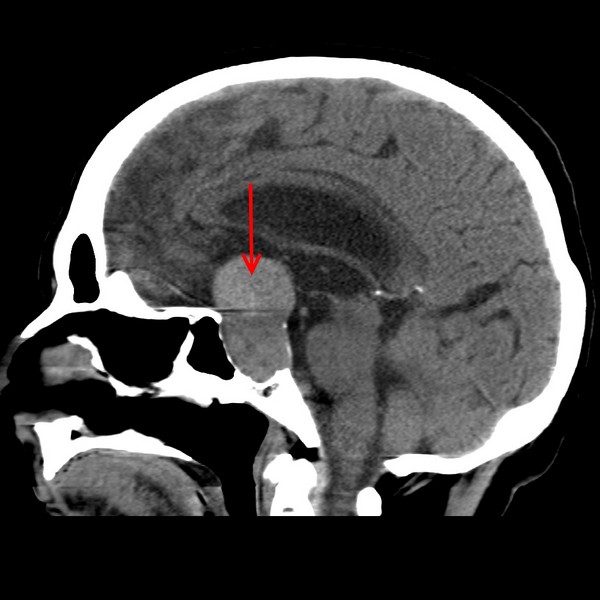 наслідки захворювання