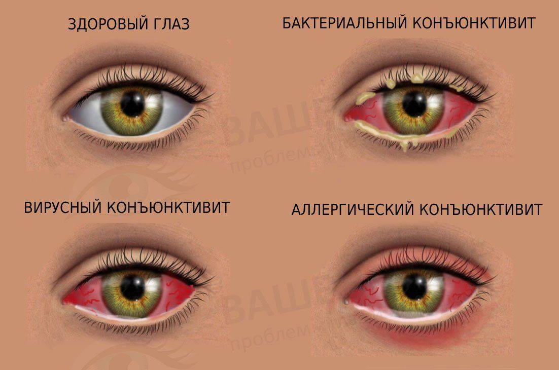 бактеріальний;   вірусний;   грибковий;   алергічний і аутоімунний;   травматичний;   метастатический