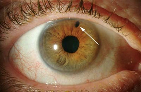 У 60% випадків глаукому виявляють уже в просунутих стадіях