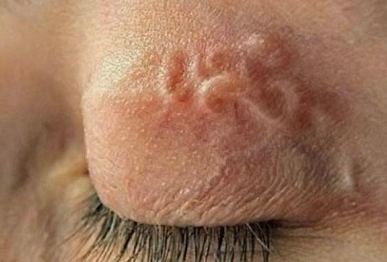 Скільки паразит жив в оці жінки, невідомо