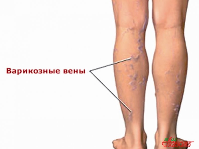 При варикозному розширенні глибоких вен єдиними ознаками варикозу можуть бути такі, як важкість у ногах і біль