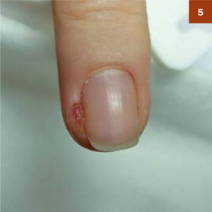 І тільки після того, як зійде запалення, грануляція «усохне», можна буде обробити кут і зайнятися його виведенням з бічного валика (фото 7)