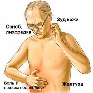 Жовтяниця має різну природу і буває: