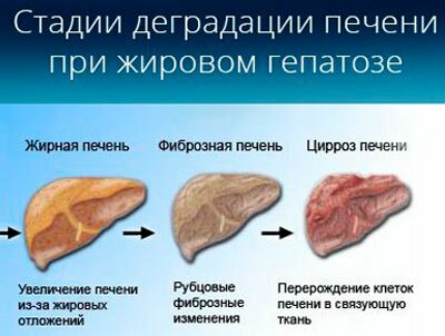 Жировий гепатоз страшний тим, що при ньому відбувається надлишкове відкладення фіброзної тканини навколо печінкових вен, що спостерігається особливо у осіб, які часто вживають алкоголь