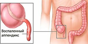 Це запалення внутрішнього органу під назвою апендикс, який представляє собою червоподібний відросток сліпої кишки