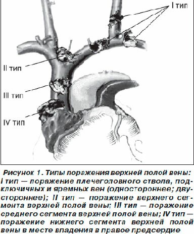 Відня великого кола кровообігу приймають кров від всіх органів тіла, і, як річки, стікаючи, утворюють порожнисті вени - верхню і нижню, які впадають в праве передсердя