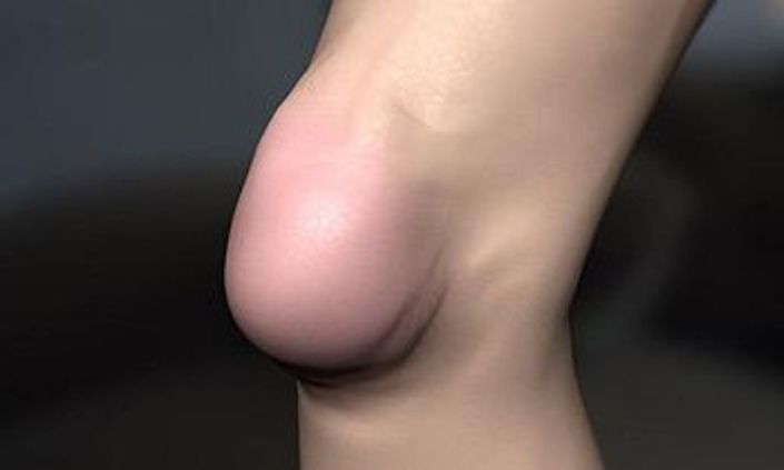 Бурсит - це запалення навколосуглобових синовіальної сумки з накопиченням в її порожнині випоту (ексудату)