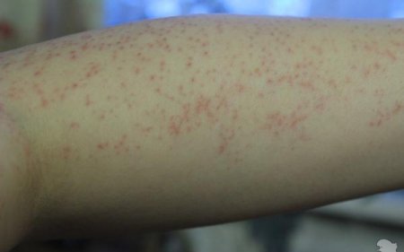 Ускладнення, отримані після епіляції, можуть викликати дискомфорт, а шкіра стає шорсткою і втрачає привабливість