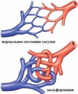 Артеріовенозна мальформация судин головного мозку проявляється тим, що капілярний ложе повністю відсутня і кров із системи артерій повністю потрапляє в систему вен