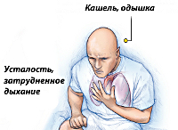 Серцево-легенева недостатність