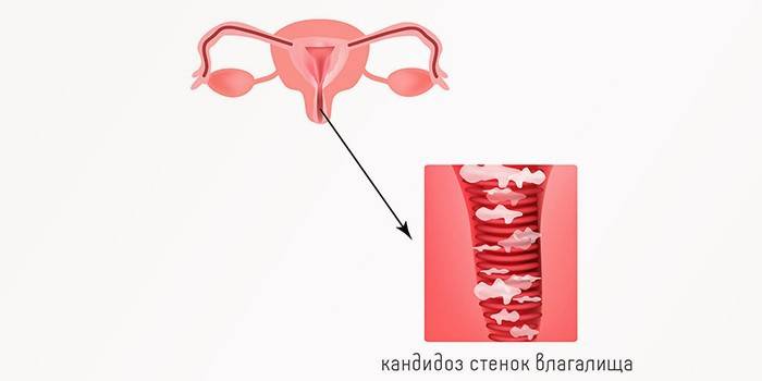 вагінальний кандидоз (лікування молочниці), викликаний Candida albicans;   бактеріальний вагініт, на тлі дії анаеробних бактерій і Gardnerella vaginalis;   трихомонадний вагініт, причиною якого стали бактерії Trichomonas vaginalis;   змішані вагінальні статеві інфекції