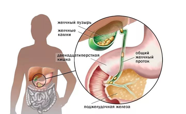 Порушення евакуаторної функції жовчного міхура, розвивається через спазм або, навпаки, атонії самого міхура або жовчовивідних шляхів, а також наявних каменів, нерідко призводить до застою жовчі