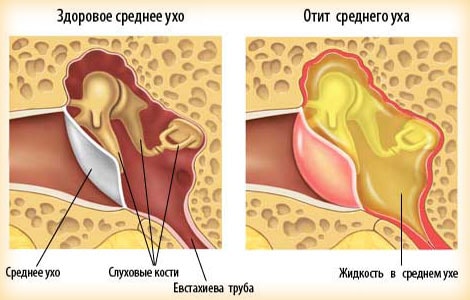Отит середнього вуха (середній отит) - це запалення, яке розвивається в просторі між барабанною перетинкою і внутрішнім вухом