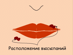 Герпес, який в стоматології часто називають просто лихоманкою, - хворобливі і неприємні на вигляд виразки, причина яких - спалах інфекції, викликаної вірусом gerpes simplex