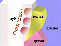 Карієс зубів - серйозна проблема в стоматології і для дорослих, і для дітей