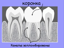 Зубні коронки - вид стоматологічної реставраціію