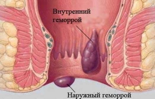 Від чого виникає зовнішня форма хвороби