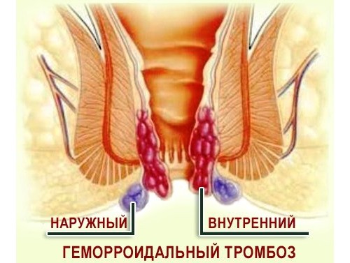 Ускладнення зовнішнього геморою