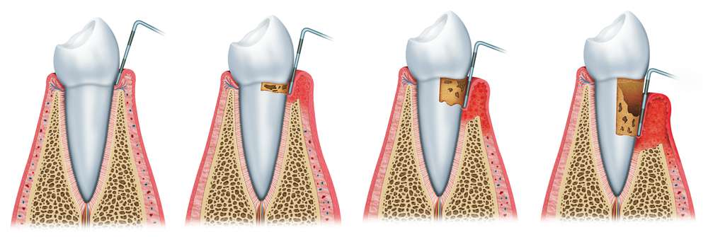 Пародонтоз следует лечить, принимая 20-30 капель растительного сока в рот, смешивая со слюной и удерживая его вокруг пораженного зуба как можно дольше
