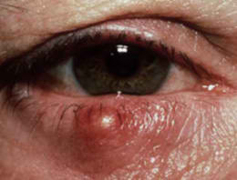 Причина виникнення ячменю на оці - потрапляння в сальну залозу інфекції, в основному жовтого стафілокока