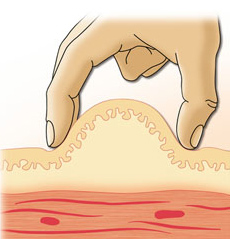 Ін'єкції під шкіру - це введення ліків в підшкірно-жировий шар, більш глибоке введення голки, ніж при внутрішньошкірної ін'єкції (наприклад, проба Манту)