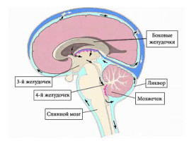 патологія   , Яка характеризується присутністю великої кількості ліквору (рідини) в черепній коробці - маса тисне на окремі ділянки головного мозку і провокує потужну, регулярну, виснажливу головний біль