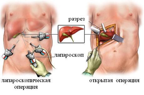 Також рекомендується прийом гепатопротекторів з оцінити ефективність