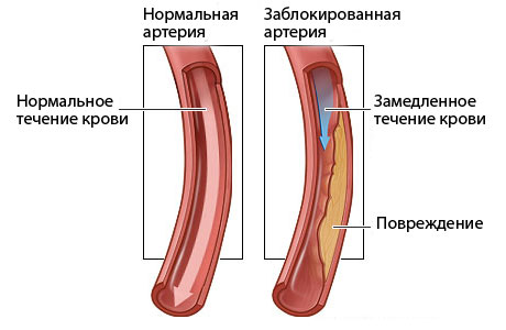 Окремі ліпопротеїни (ліпопротеїни високої щільності - ЛПВЩ) транспортують надлишок холестерину з клітин периферичних тканин в печінку, де вони окислюються в жовчні кислоти