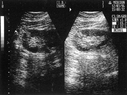 Ехографіческая картина полікістозу нирок (ліва нирка обведена курсором)